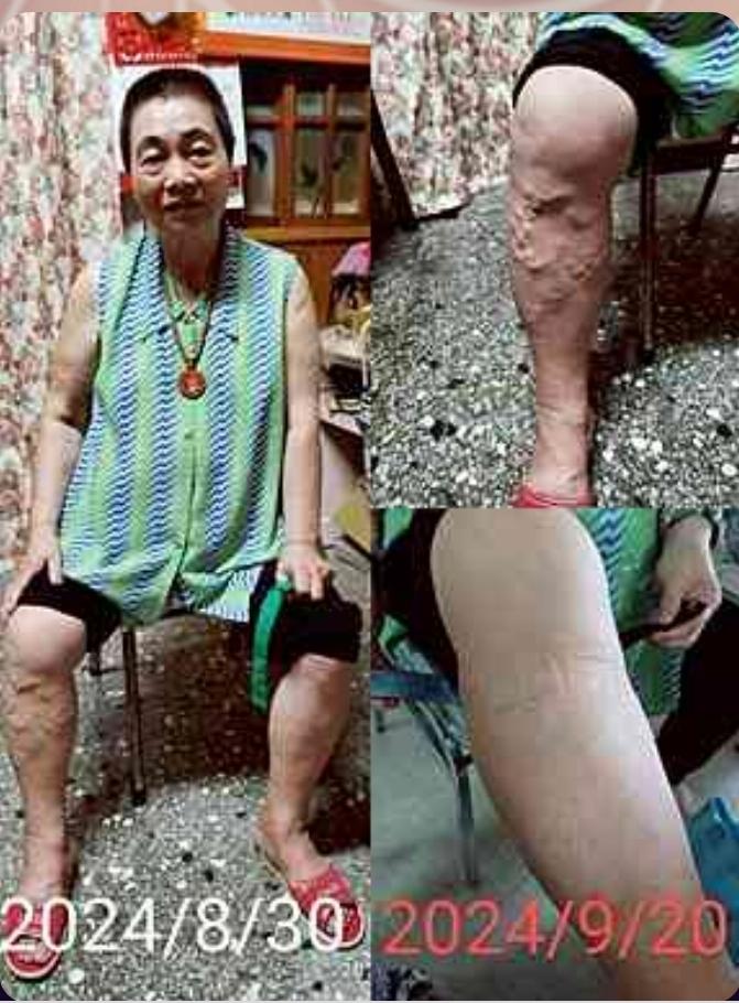 ?分享一位使用者的回饋｜右腳靜脈曲張 20 天的變化